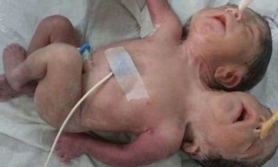 Em bé sinh ra có 2 đầu 3 cánh tay chỉ sống được vài giờ tại Ấn Độ