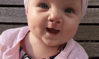 Bé gái 7 tháng tuổi cười và phát âm ngay sau lần phẫu thuật hở hàm ếch đầu tiên 