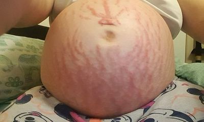 Bà mẹ dị ứng suốt quá trình mang thai bất ngờ khi nhìn thấy cơ thể sau khi sinh