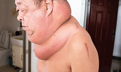 Người đàn ông 13 năm sống trong 'địa ngục' vì khối u khổng lồ trên cổ