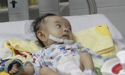 Phẫu thuật cho bé gái Sóc Trăng bị dị tật tim hiếm gặp trên thế giới