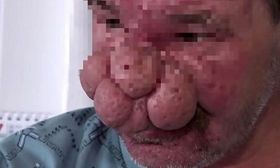 Người đàn ông có chiếc mũi 'khổng lồ' được phẫu thuật thành công