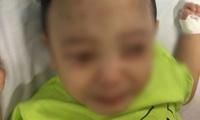Sức khỏe của bé trai 1 tuổi bị bạo hành ở Hà Nội tiến triển tốt
