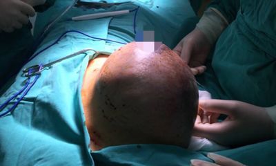 Sau sinh 2 ngày, sản phụ được phẫu thuật cắt khối u khổng lồ trên ngực phải