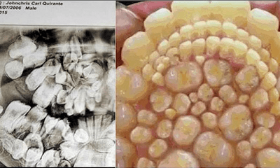 Ca bệnh kì lạ: Thiếu niên có tới 232 chiếc răng mọc thừa 