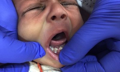 Em bé sinh ra đã có 7 chiếc răng 