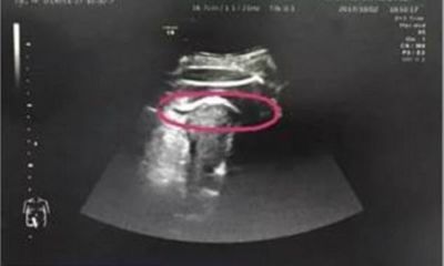 Thai nhi đạp thủng tử cung khiến bà mẹ trẻ suýt tử vong