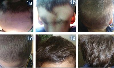 Điều trị thành công rụng tóc từng vùng bằng thảo dược