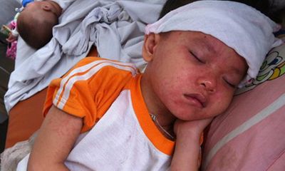 Bệnh sởi gia tăng: Phân biệt bệnh sởi với sốt phát ban ở trẻ em
