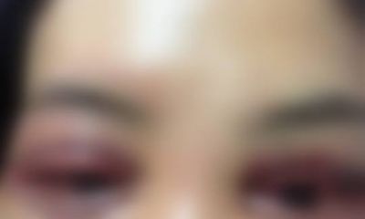 Sở Y tế Hà Nội chỉ đạo làm rõ vụ nữ khách hàng tố Spa cắt mí mắt hỏng
