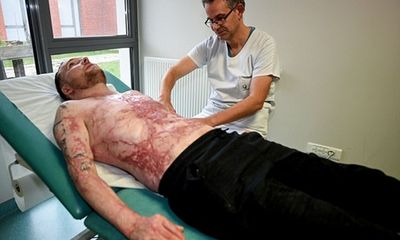 Người đàn ông bỏng 95% cơ thể được 'tái sinh' sau khi cấy ghép da từ anh trai 