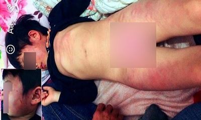 Vụ cháu bé bị đánh bầm tím ở trường Mầm non tại Bắc Giang: Kỷ luật 3 cô giáo 