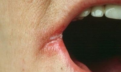 Điều trị viêm góc môi xảy ra trong mùa lạnh
