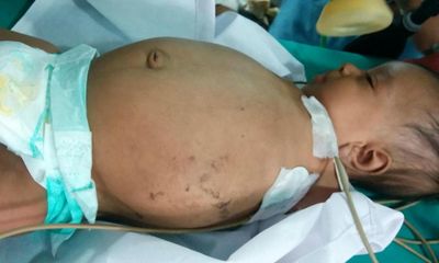 Bé trai 3 tháng chào đời với một bào thai kí sinh trong bụng