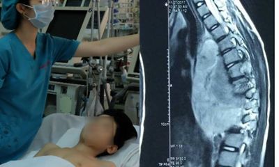 Phẫu thuật cứu bé trai bị khối u 1,5 kg chèn tim phổi, liệt chân