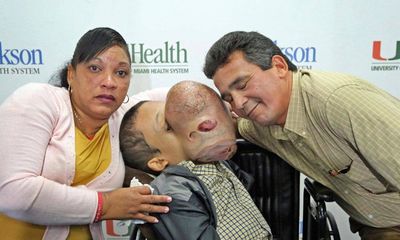 Cậu bé toàn thân dị dạng, khối u che kín mặt vì mắc căn bệnh lạ