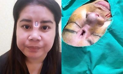 Phẫu thuật hỏng, cô gái trẻ đau đớn vì thanh silicone đâm thủng mũi chòi ra giữa mặt