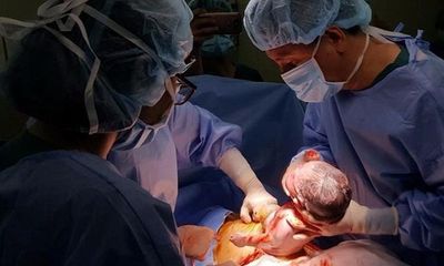 Bé sơ sinh bị thoát vị rốn lồi ruột gan ra ngoài được cứu sống