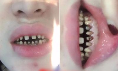 Rùng mình với hàm răng bị hư hỏng nặng của cô gái ở Hà Nội sau 2 năm bọc sứ