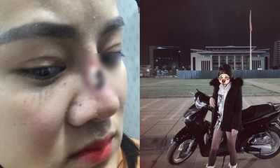 Cô gái trẻ 'ôm mũi hỏng' đến bắt đền chủ spa 17 tuổi gây xôn xao