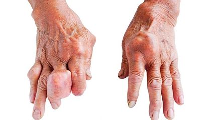 Nguyên nhân và triệu chứng thường gặp của bệnh gout