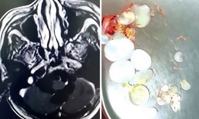Lúc nhúc 30 trứng sán dây trong não