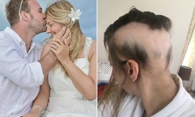 Cô dâu rụng 90% tóc trên đầu vì quá lo lắng chuẩn bị cho đám cưới