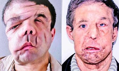 Người đàn ông có 3 khuôn mặt sau 2 lần cấy ghép