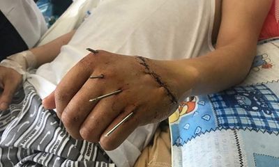 BV Đà Nẵng: Nối thành công bàn tay đứt lìa cho một bệnh nhân