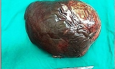 Cắt bỏ khối u gan nặng 5 kg cho bệnh nhân mắc bệnh lý hiếm gặp trên thế giới