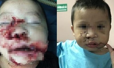 Phẫu thuật tạo hình thành công cho bé trai 2 tuổi bị chó cắn nát mặt