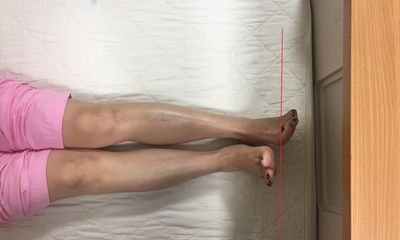 Sau phẫu thuật thay khớp háng tại BV 108: Bệnh nhân bị “chân dài, chân ngắn”
