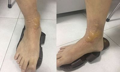 Đi massage người đàn ông ở Hà Nội bị bỏng rộp chân