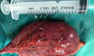 Quảng Ninh: Phẫu thuật nội soi lồng ngực cắt bỏ khối u 