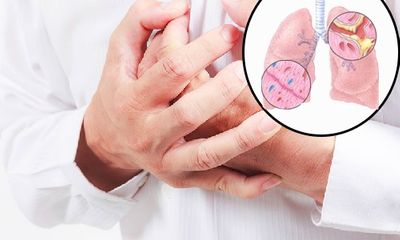 Những dấu hiệu nhận biết ung thư phổi thường bị bỏ qua