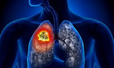 Bệnh ung thư phổi nguy hiểm như thế nào?