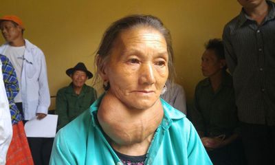 Người phụ nữ có khối u khổng lồ trên cổ