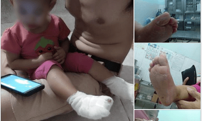 Bảo mẫu mở nhầm vòi nước nóng, bé gái 18 tháng tuổi bị bỏng 2 bàn chân