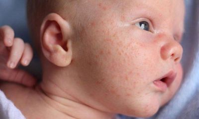 Các bệnh ngoài da thường gặp ở trẻ sơ sinh