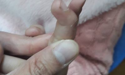 Hà Nội: Bé gái có ngón tay bị tật do mẹ tự chữa đứt tay ở nhà