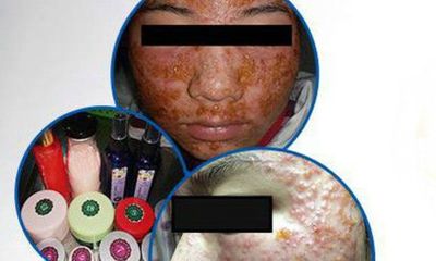 Tin tức đời sống mới nhất ngày 21/12/2018: Nữ sinh 19 tuổi biến dạng da mặt vì tự làm đẹp đón Tết