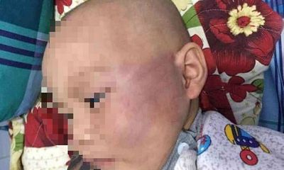 Vĩnh Long: Bảo mẫu tát bé trai 19 tháng tuổi tím bầm mặt, nói dối ngã cầu thang