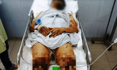 Tin tức pháp luật mới nhất ngày 15/2/2019: Việt kiều Canada bị tạt axit, cắt đứt gân chân khi về quê ăn Tết