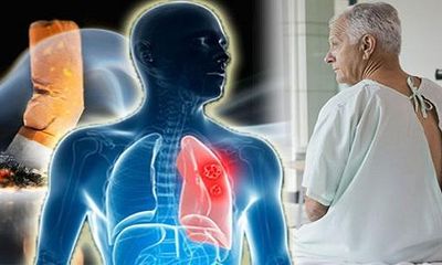 Ung thư phổi giai đoạn 2: Nguyên nhân, đặc điểm, triệu chứng của bệnh
