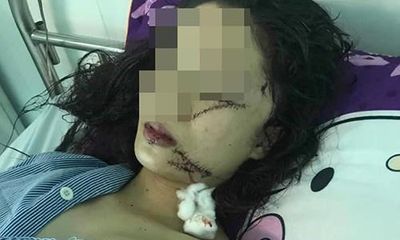Tin tức pháp luật mới nhất ngày 23/4/2019: Lộ nguyên nhân bất ngờ vụ cô gái 18 tuổi bị rạch mặt, khâu 60 mũi