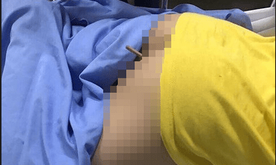 Bé trai 9 tuổi nhập viện cấp cứu vì bị bút chì đâm xuyên mông sau trò đùa của bạn học