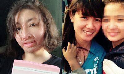 Hành trình hồi sinh của cô gái xinh đẹp bị chồng tẩm xăng đốt gần 3 năm trước