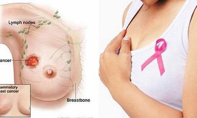 Tổng hợp 3 cách phát hiện sớm bệnh ung thư vú