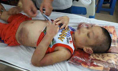 Tây Ninh: Bé trai 6 tuổi bị mẹ và bạn tình đồng tính bạo hành dã man