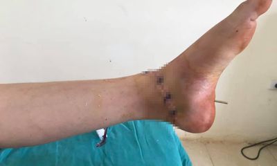 Sơn La: Nối cổ chân bị đứt lìa cho nữ giáo viên mầm non 